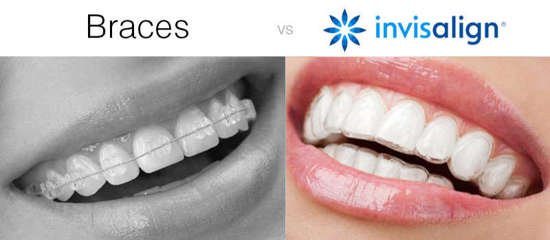 braces-vs-invisalign
