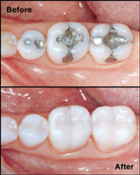 chairside-economical-restoration-of-esthetic-ceramic-before-after chairside-economical-restoration-of-esthetic-ceramic-before-after