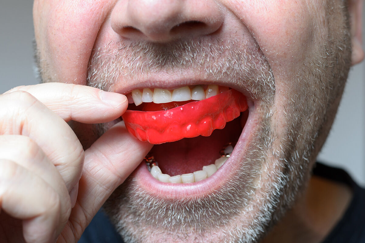 custom-fitted-mouthguards1