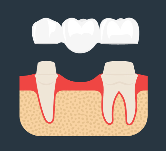 dental-bridge-dublin-dental-care