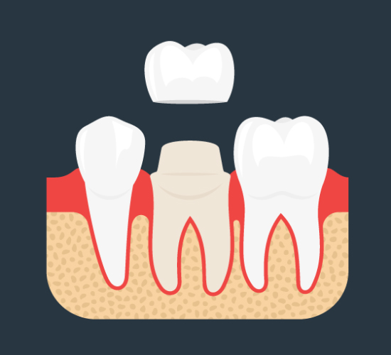 dental-crowns-dublin-dental-care