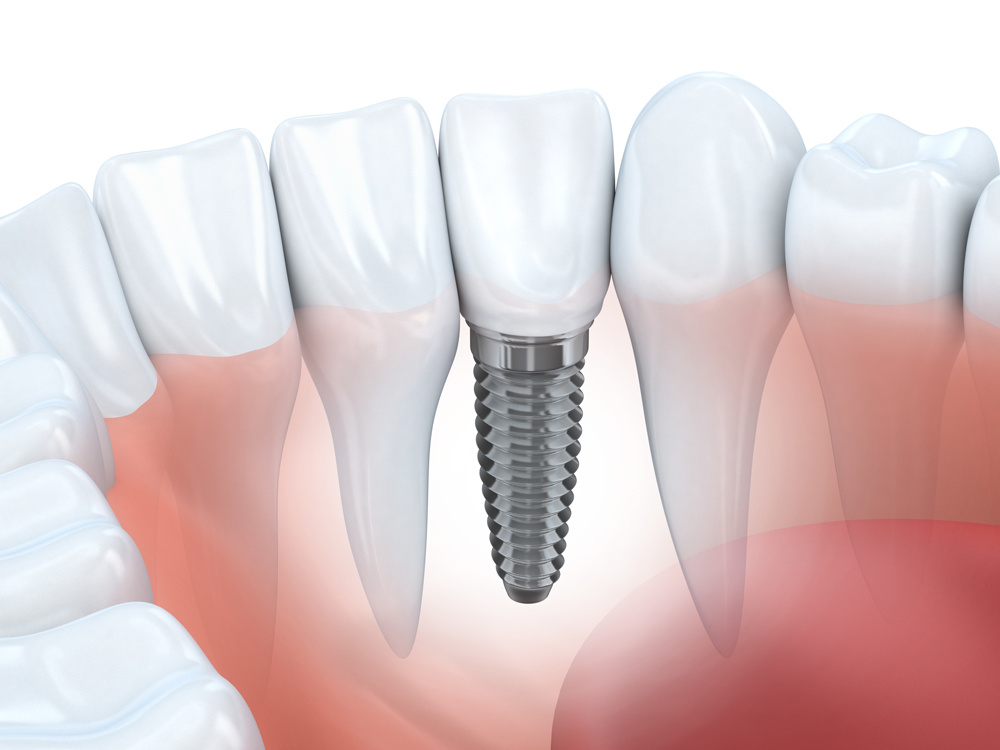 dental-implant-dublin-dental-care1