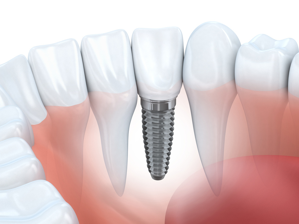 dental-implant-dublin-dental-care1 dental-implant-dublin-dental-care1