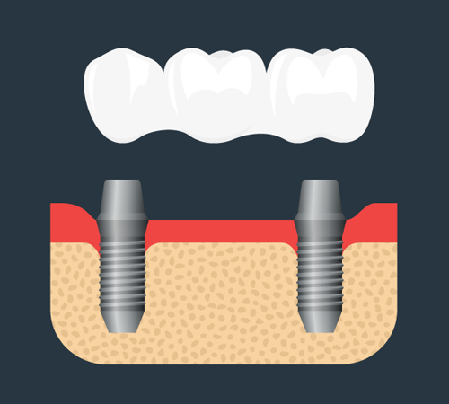 implant-supported-bridge