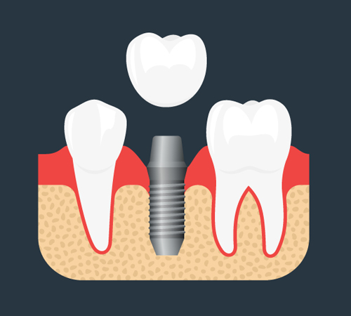 implant-supported-crowns