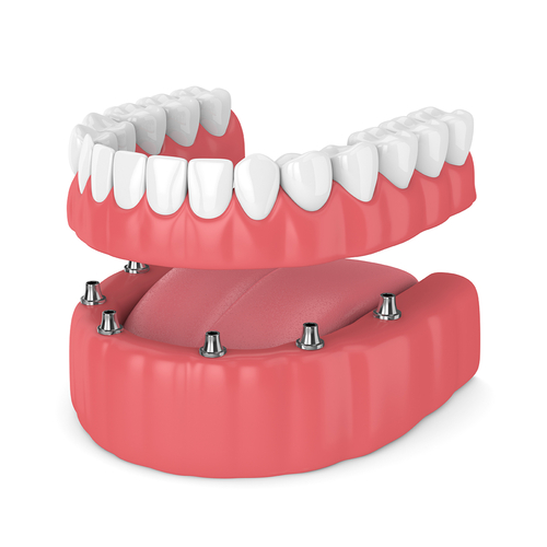 implant-supported-removable-dentures