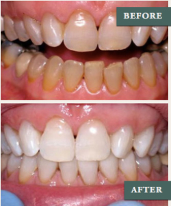 kor-whitening-before-after
