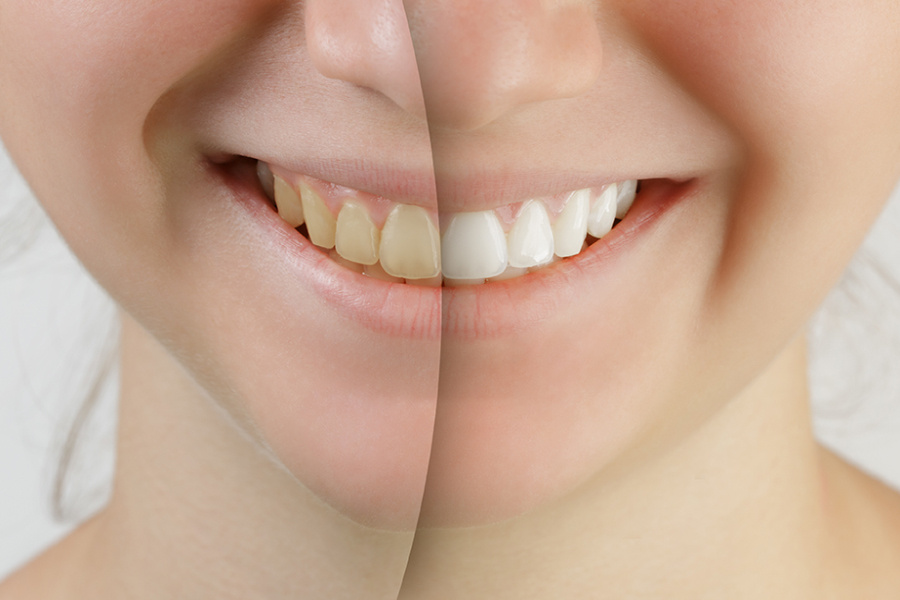 teeth_whitening_before_after1 teeth_whitening_before_after1